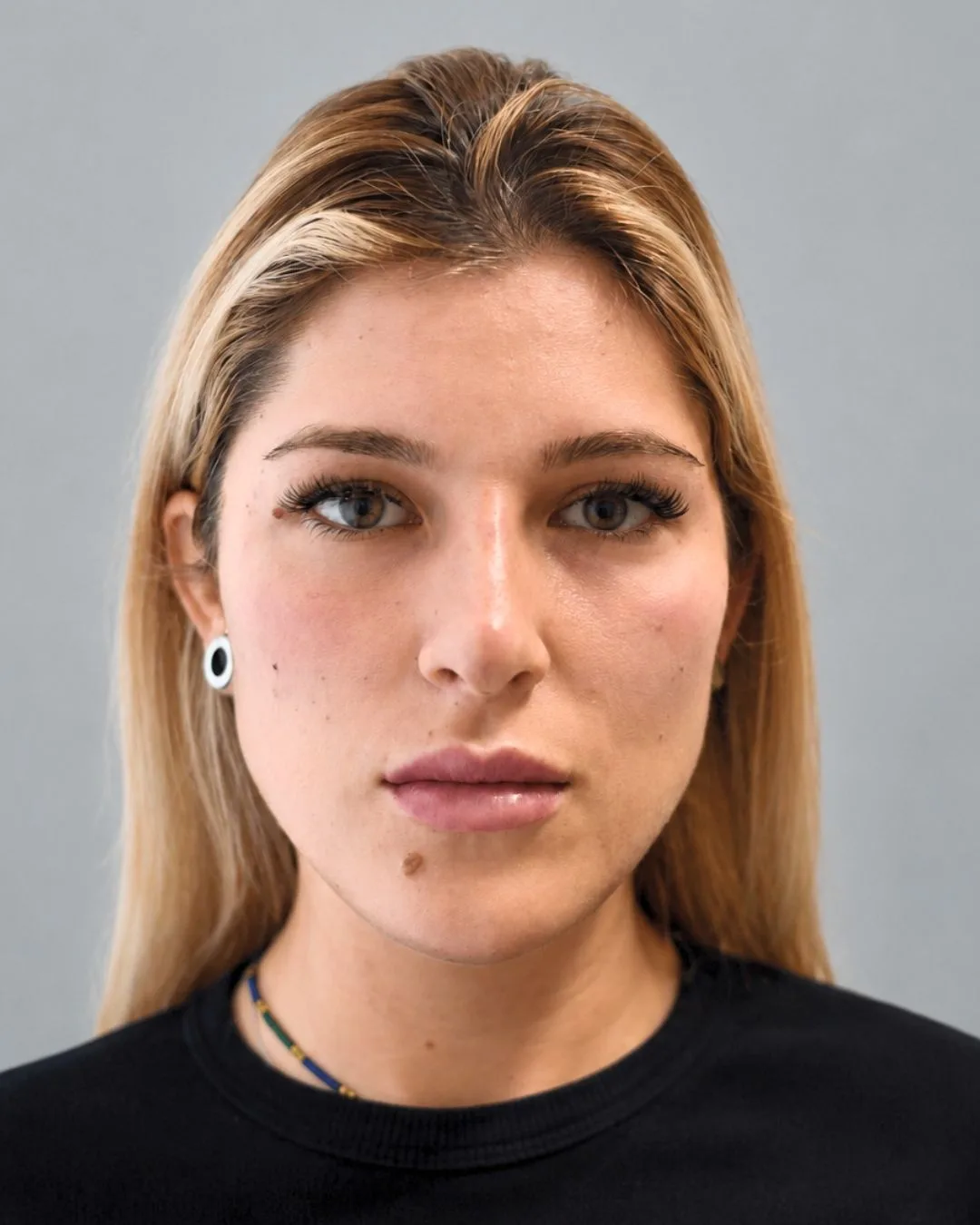 Paziente FaceLine® , dopo il protocollo