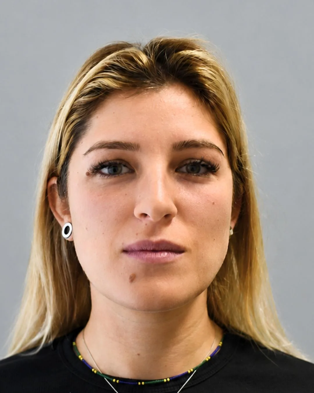 Paziente FaceLine® , prima del protocollo