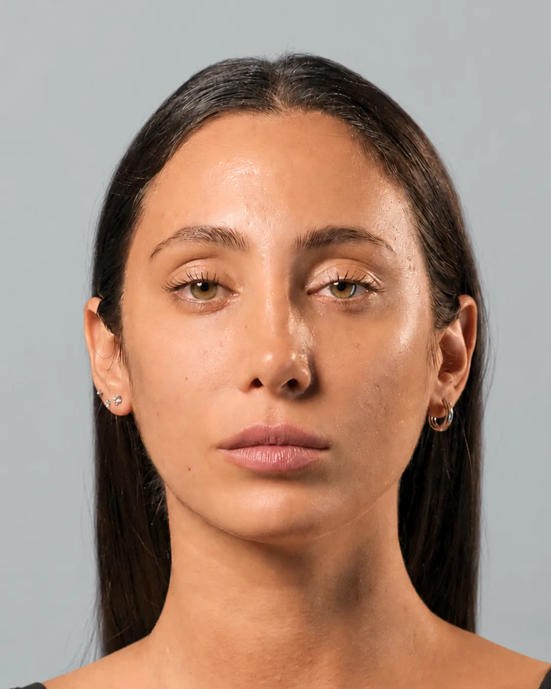 Paziente FaceLine® , prima del protocollo
